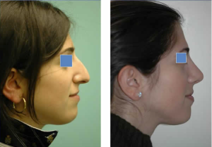 Rhinoplasty Before and After Pictures Cleveland, OH